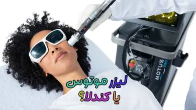لیزر موتوس و کندلا
