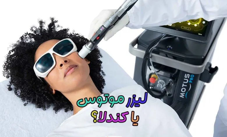 لیزر موتوس و کندلا