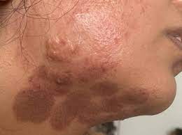 اگر با دستگاه لیزر مو دچار سوختگی و سوزش شدیم چه کنیم