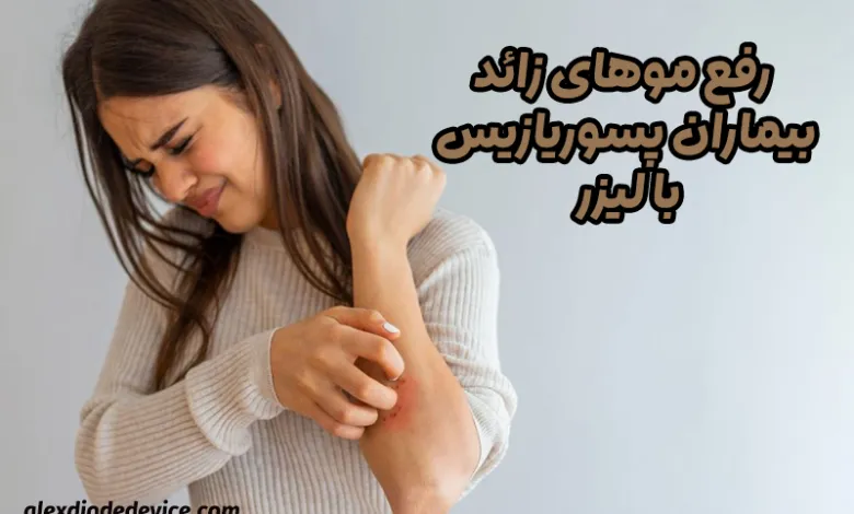 رفع موهای زائد بیماران پسوریازیس با لیزر