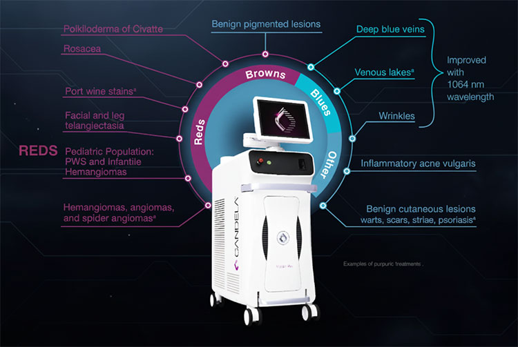 دستگاه Vbeam® | لیزر رنگی پالسی برای عروق پوستی
